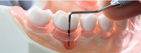 牙周病囊袋測量-均潔數位雷射植牙中心